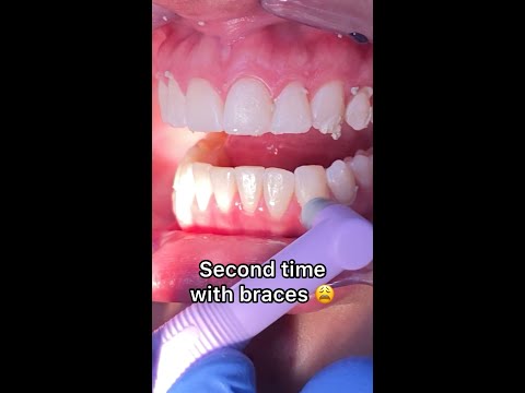 What happens if you get braces a second time? Tooth Time Family Dentistry New Braunfels Texas