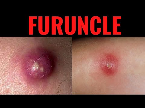 What is Furuncle? Furuncle (Boil) Definition,Causes, Symptoms, Risk Factors, USMLE