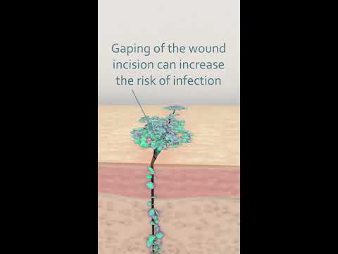 What causes wound infection?