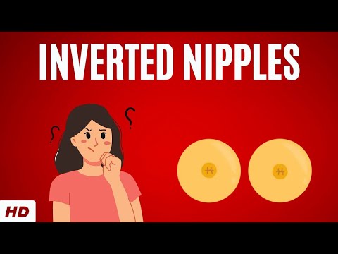 Inverted Nipples: Everything You Need To Know