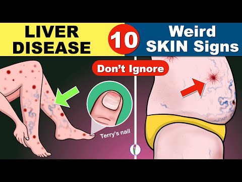 10 Skin signs of Liver Disease | Fatty liver | Cirrhosis of the Liver | Fatty liver Symptoms