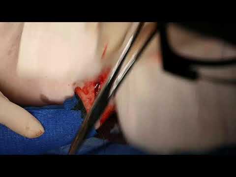 live stream bilateral ulnar osteotomies in a dog with radius curvus