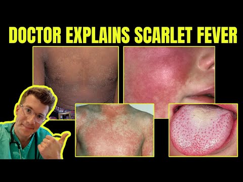 Doctor explains SCARLET FEVER (Group A Streptococcal disease) - CAUSES, SYMPTOMS & TREATMENT